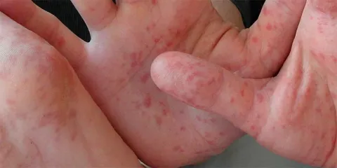 Zmiany skórne pojawiające się w przebiegu bostonki 