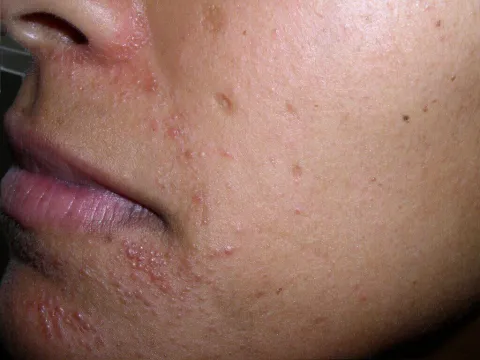 Zmiany skórne w ciąży zdjęcia zapalenie okołoustne 