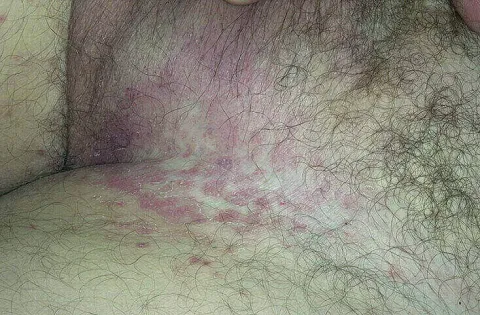 Zmiany skórne w pachwinie