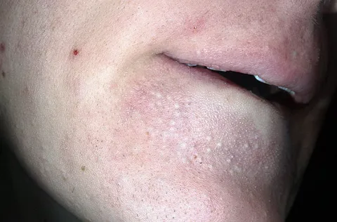 białe grudki na brodzie zaskórniki zamknięte