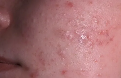 białe grudki na policzkach zaskórniki zamknięte