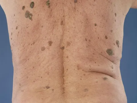 brodawki łojotokowe na plecach