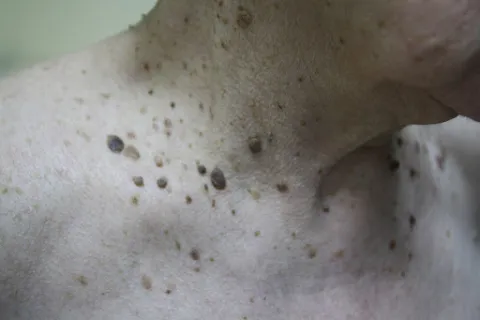 brodawki łojotokowe na szyi