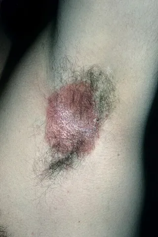 czerwone plamy pod pachami odparzenia