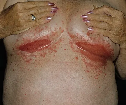 czerwone zmiany skórne pod piersiami odparzenia