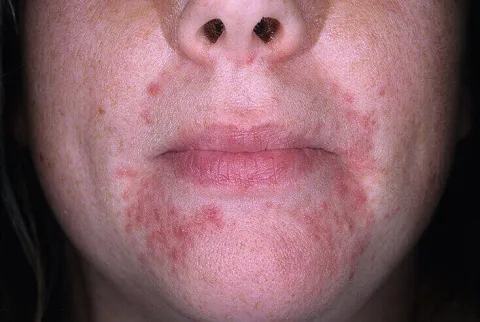 dermatoza okołoustna