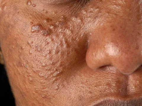 Gruczolaki potowe (syringoma)