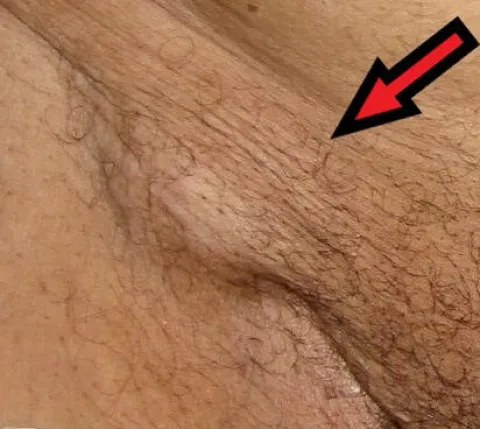 guz w okolicach pachwiny