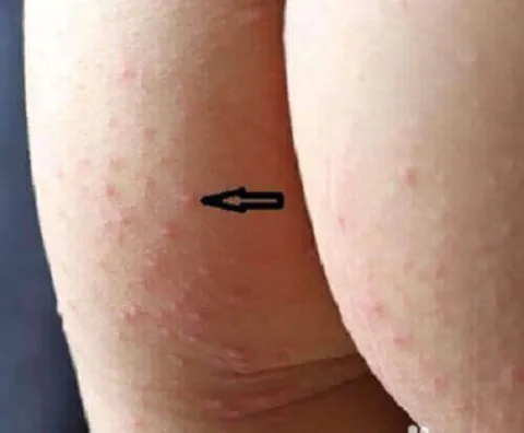 krostki na pośladkach u dziecka