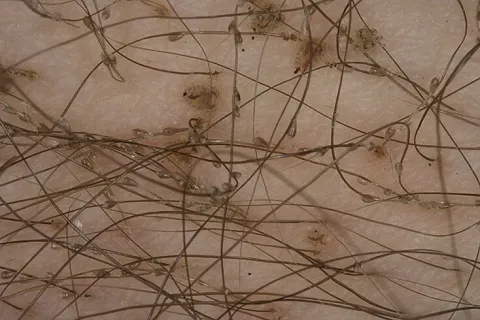 martwe gnidy we włosach