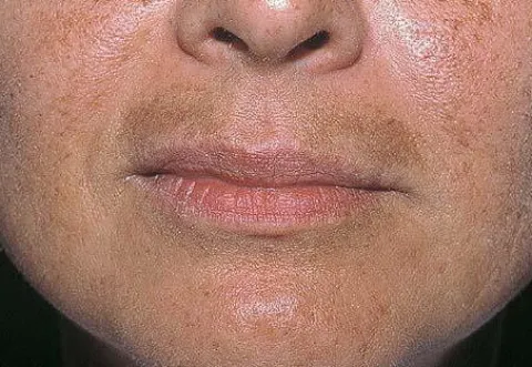 melasma nad ustami