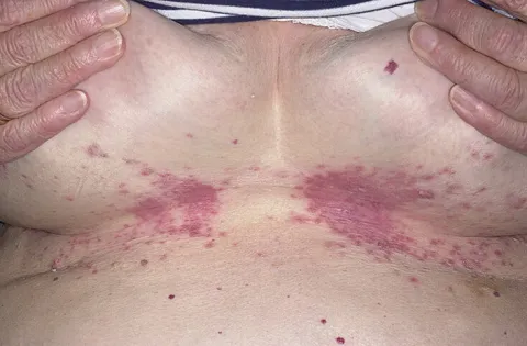 odparzenia pod biustem zdjęcia