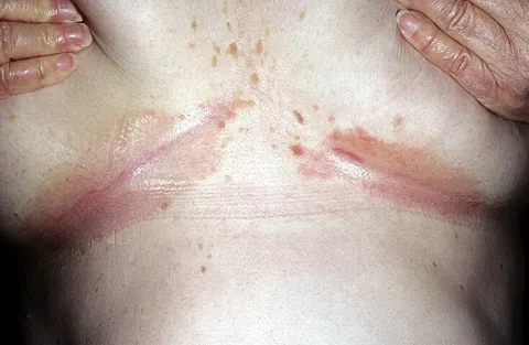 odparzenia pod biustem zdjęcia