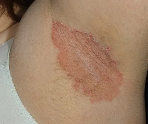 odparzenia pod pachami