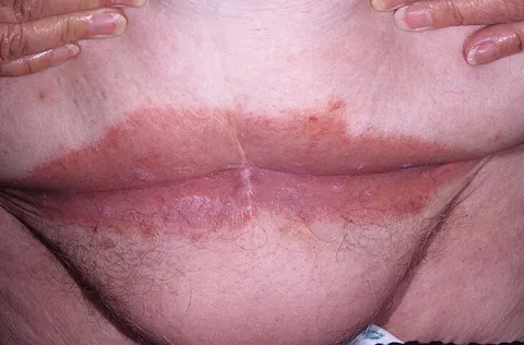 odparzenia w fałdach skórnych