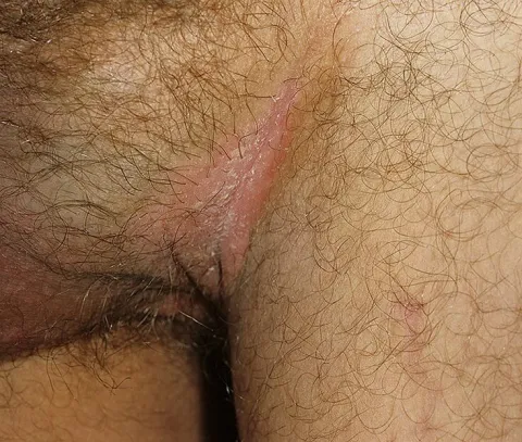odparzenia w okolicach intymnych