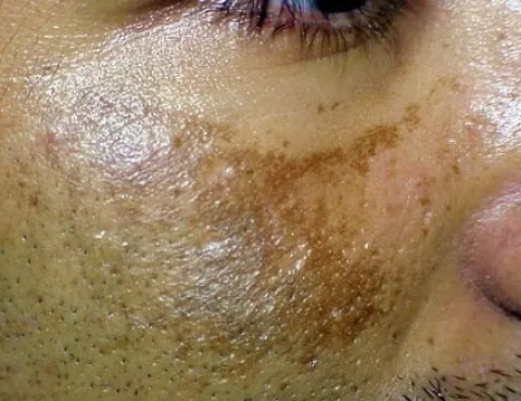 plamy na skórze zdjęcia