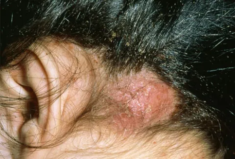 ropień po ukąszeniach wszy