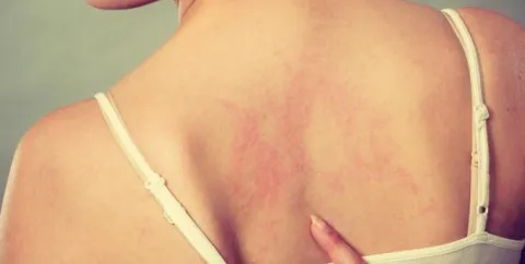 uczulenie na opalanie