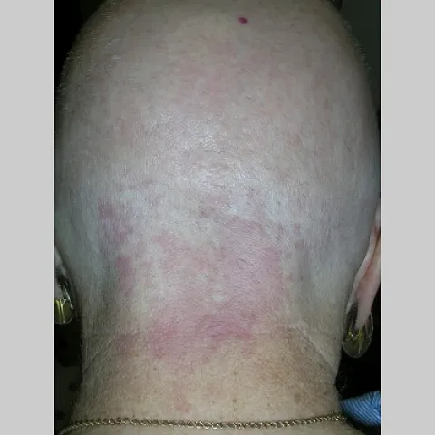 uszczypnięcie bociana u dorosłych 