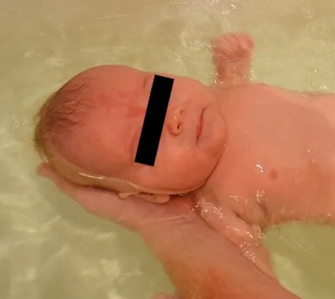 uszczypnięcie bociana u noworodka