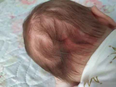 wrodzona rumieniowa plamka uszczypnięcie bociana