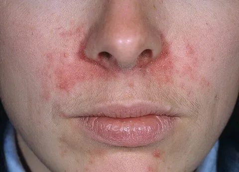 wysypka na twarzy u dorosłych 
