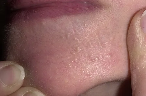 zaskórniki zamknięte na twarzy