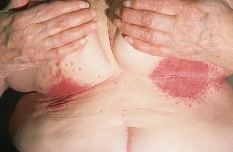 zdjęcia odparzeń pod piersiami