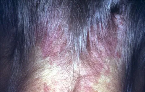 znamię naczyniowe płaskie na szyi u dorosłego