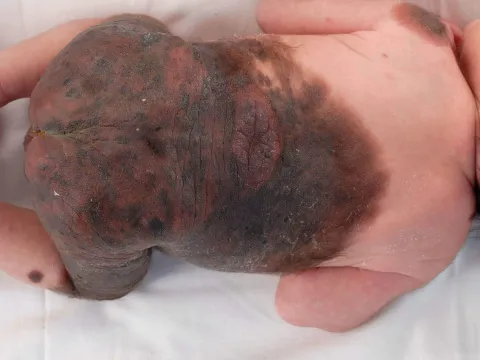 znamiona olbrzymie u dziecka