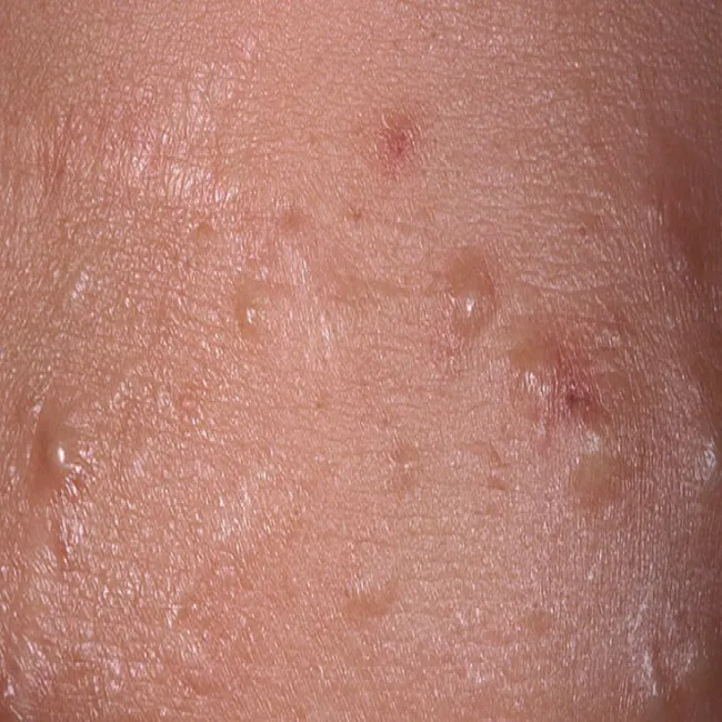 Łagodne zmiany skórne zaskórniki zamknięte