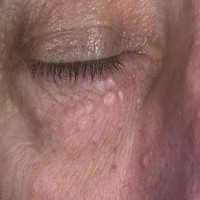 Łagodny gruczolak potowy (syringoma) 