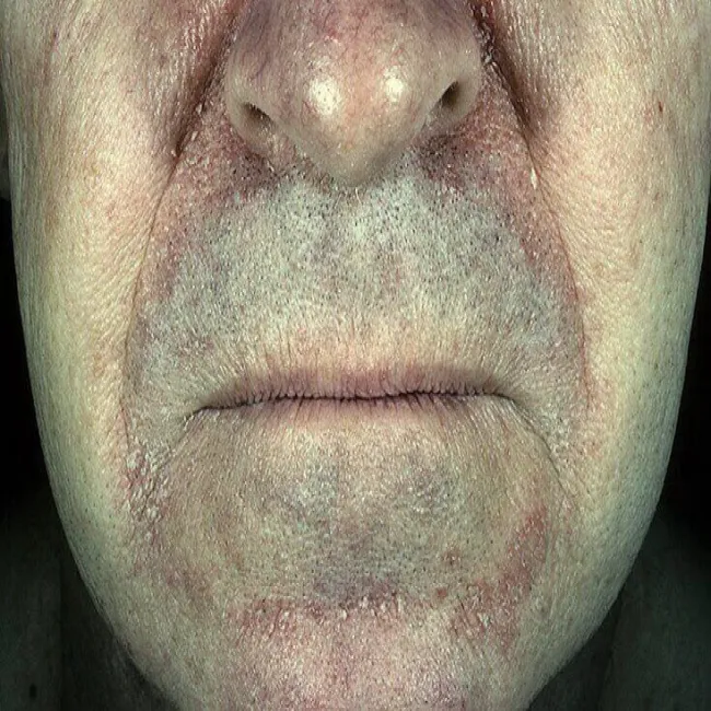 Łojotokowe zapalenie skóry objawy