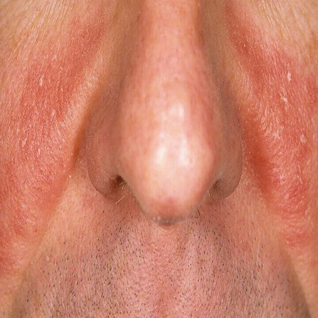 Łojotokowe zapalenie skóry twarzy