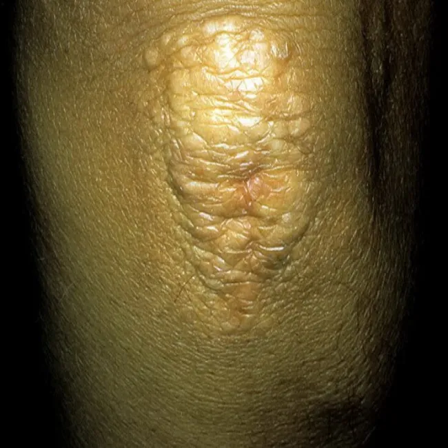 Łokieć zmiany skórne kępki żółte guzkowe 