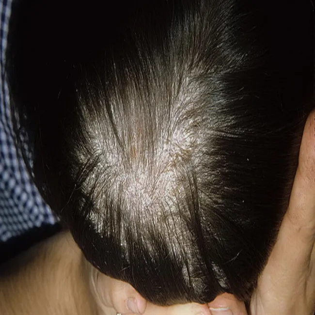 Łuszcząca się skóra głowy u dziecka