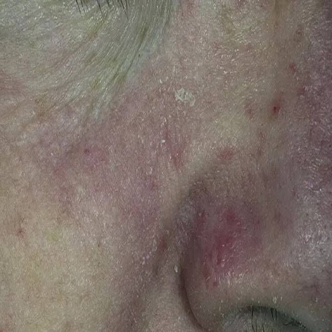 Łuszcząca się skóra koło nosa 