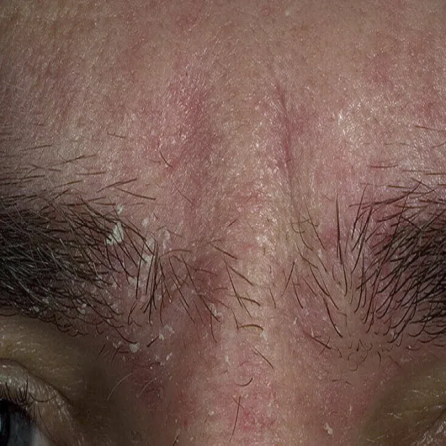 Łuszcząca się skóra między oczami 