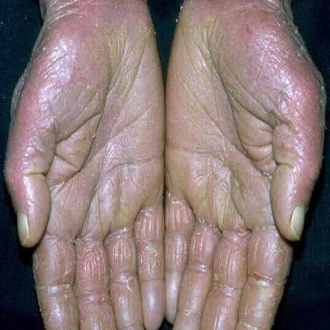 Łuszcząca się skóra na dłoniach zespół Sezary’ego 