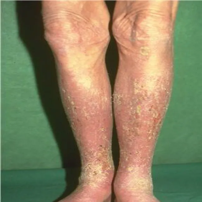  Łuszczące się plamy na nodze wyprysk podudzi