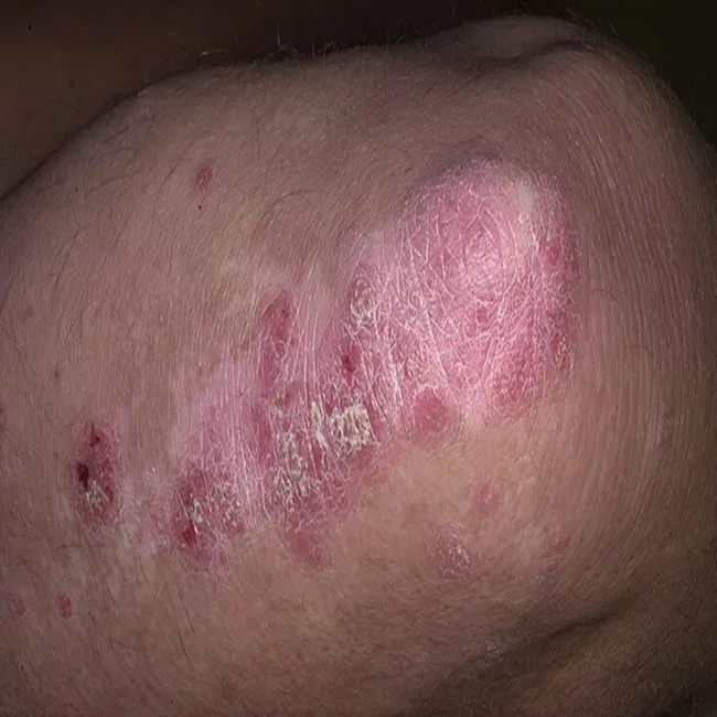 Łuszczyca na łokciu