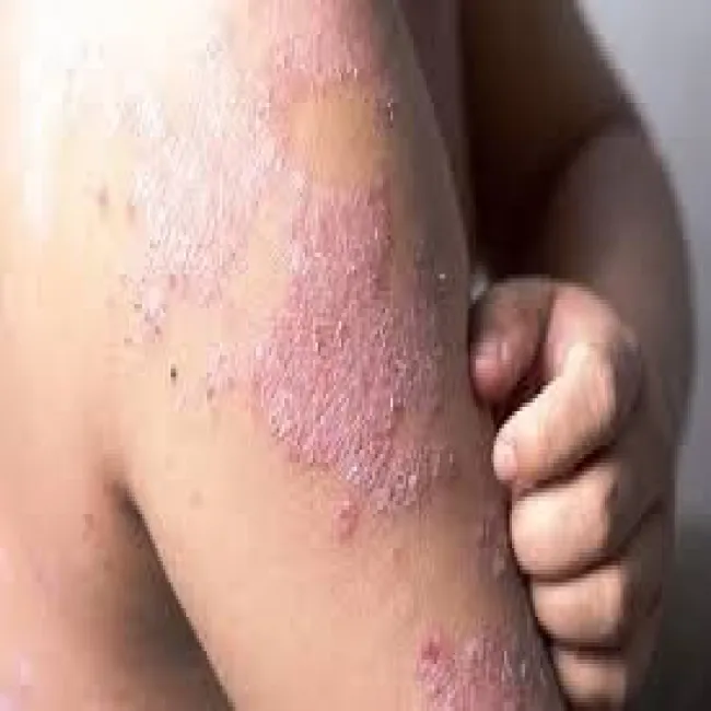 Łuszczyca na ramieniu