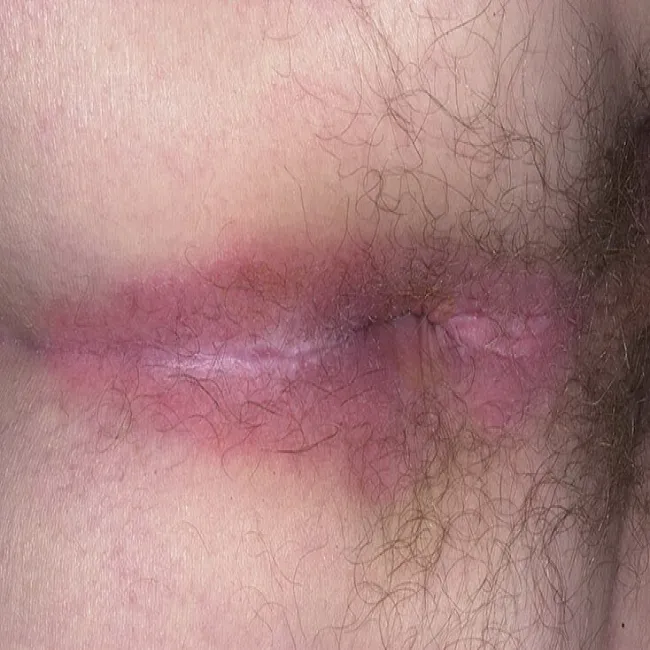 Łuszczyca w okolicy odbytu 