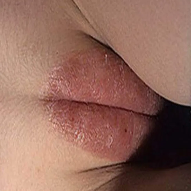 Łuszczyca warg sromowych