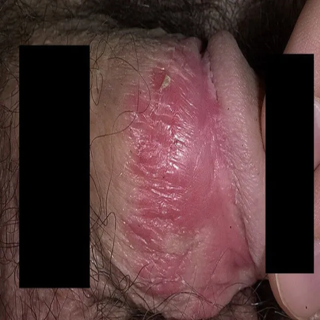 Łuszczyca zapalenie napletka