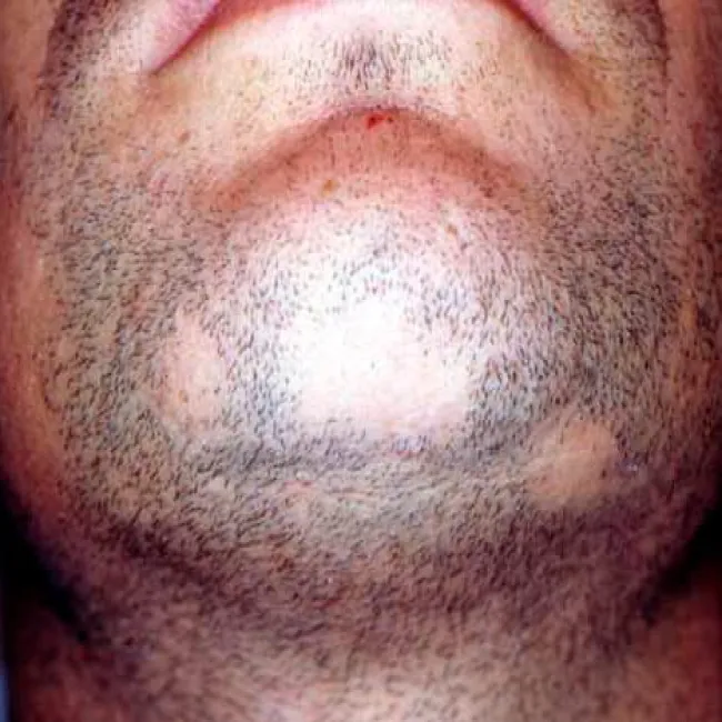 Łysiejące miejsce na brodzie łysienie plackowate