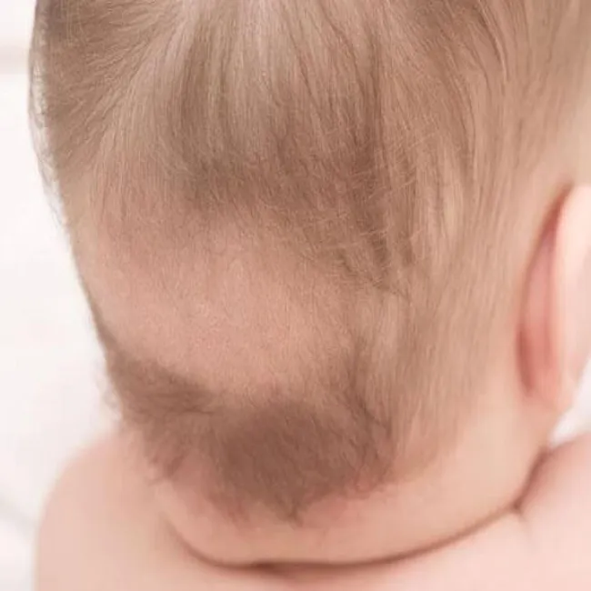 Łysy placek na głowie u niemowlaka