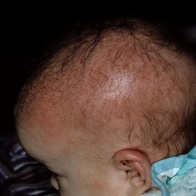 łojotokowe zapalenie skóry głowy u niemowląt