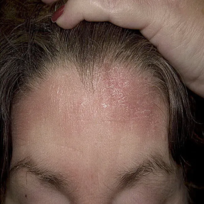 łojotokowe zapalenie skóry na czole